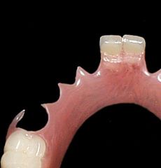 Flexite Flexible Partial Denture
