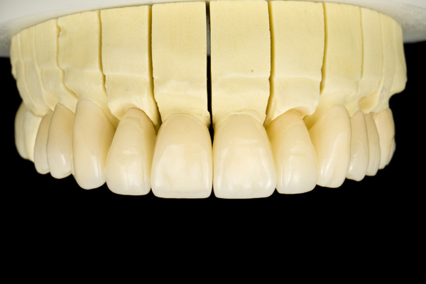 Porcelain Zirconium Inlay Bridge