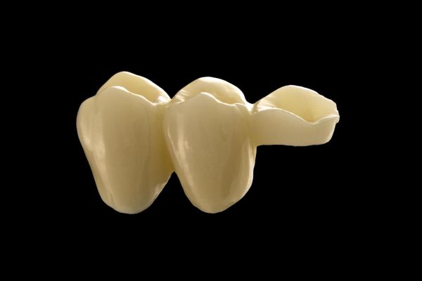 Porcelain Zirconium Inlay Bridge