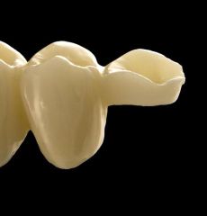 Porcelain Zirconium Inlay Bridge