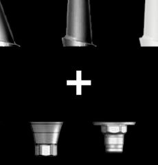 Custom Implant Abutment Alternatives