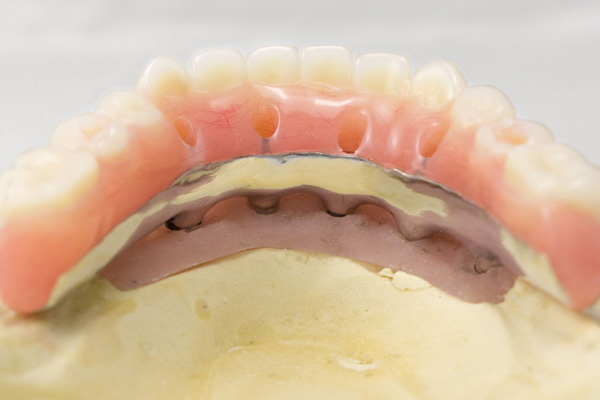 Hybrid Denture