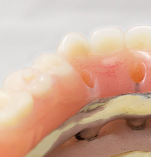 Hybrid Denture