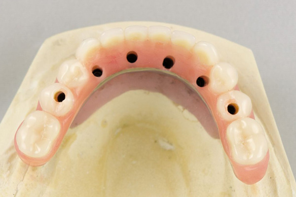 Hybrid Denture