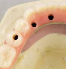 Hybrid Denture