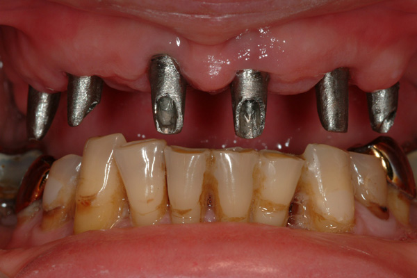 Test Fit the Abutments