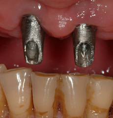 Cement and Screw Retained Implant Restorations