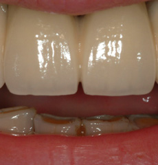 Hybrid Dentures