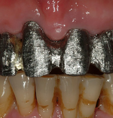 Implant Bar Overdentures