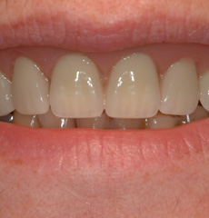 Patient 1: Denture Try In