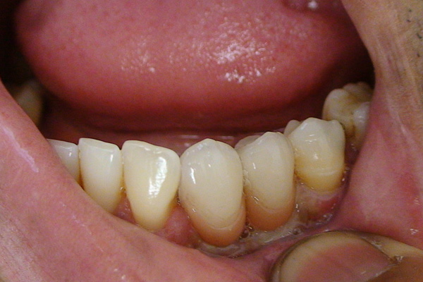 Finished screw retained crowns