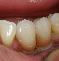 Final Crowns