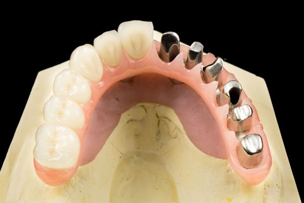 Milled Preparation for the Crowns