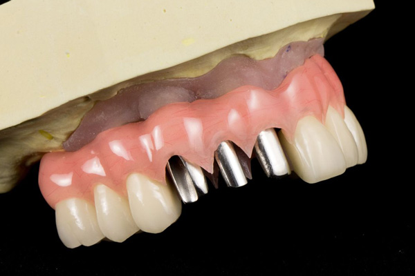 Buccal Facing Screw Holes
