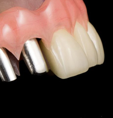 Implant Gallery
