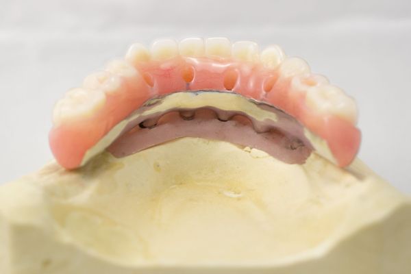 Hybrid Dentures