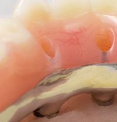 Hybrid Dentures