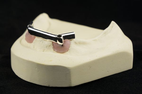 Implant Bar Overdentures