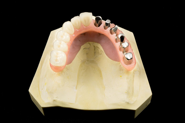 Cement and Screw Retained Implant Restorations