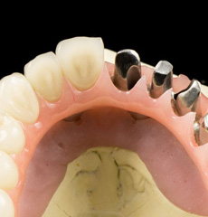 Cement and Screw Retained Implant Restorations