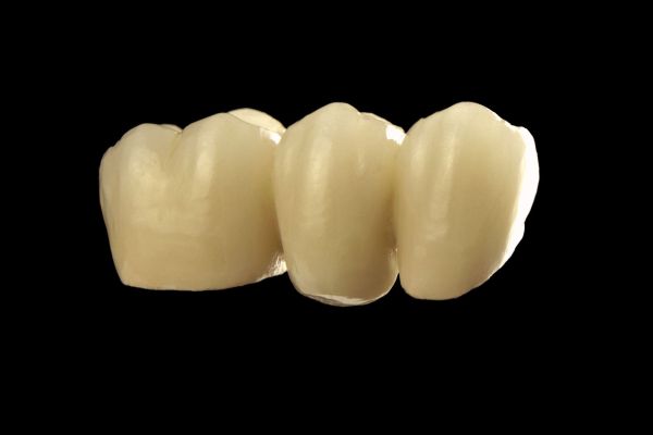 Porcelain fused to Metal Bridge